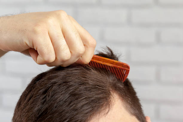 How Much Does Hair Transplant Cost with FUE Technique?