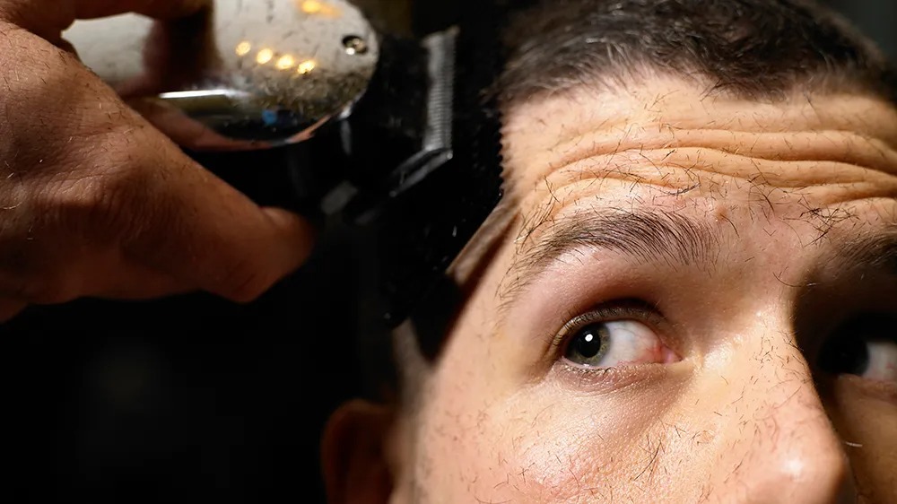 The Ultimate Guide to Hair Transplant London Procedures