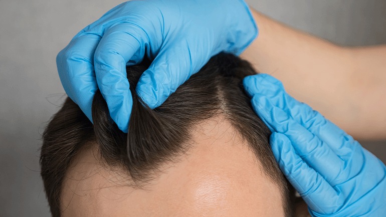 Hair Transplant Istanbul: Step-by-Step Journey to New Confidence