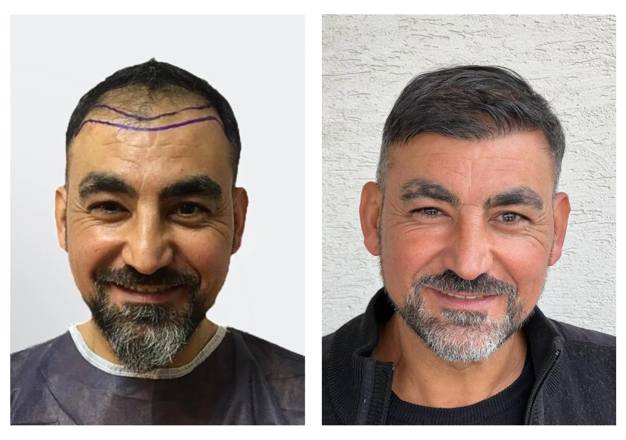 Hair Transplant London – Book Your Free Consultation Today